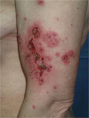 Case Report: Rowell Syndrome–Like Flare of Cutaneous Lupus Erythematosus Following COVID-19 Infection